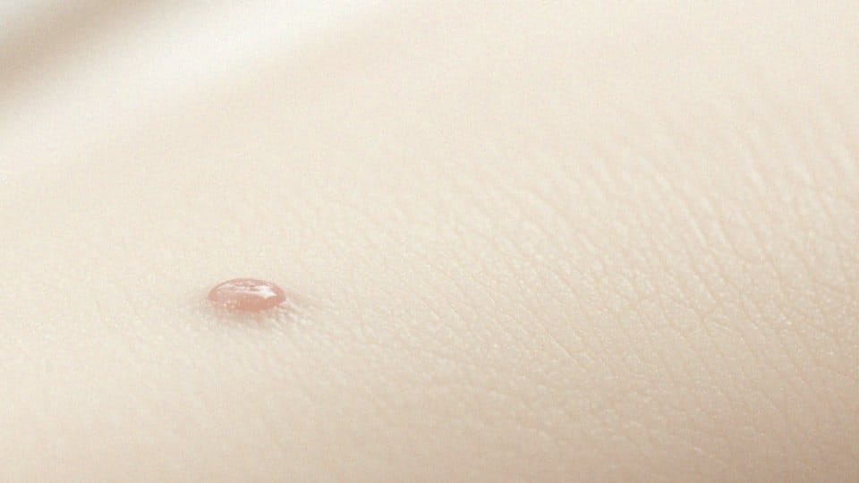 Czy migracja kwasu się wchłonie? Wyjaśniamy zjawisko migracji